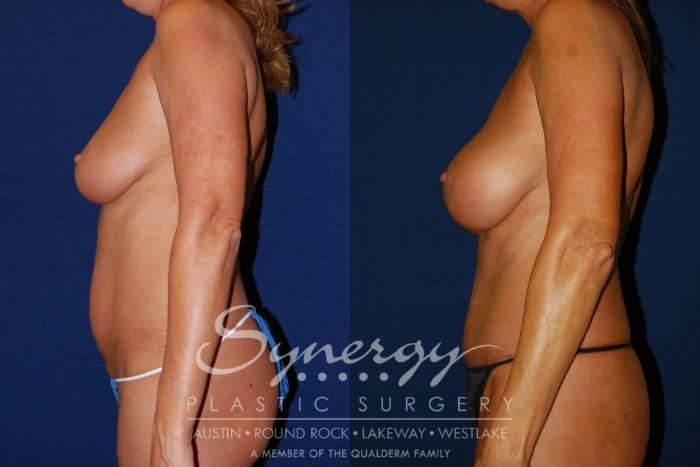 Before & After Mommy Makeover Case 96 View #5 View in Austin, TX