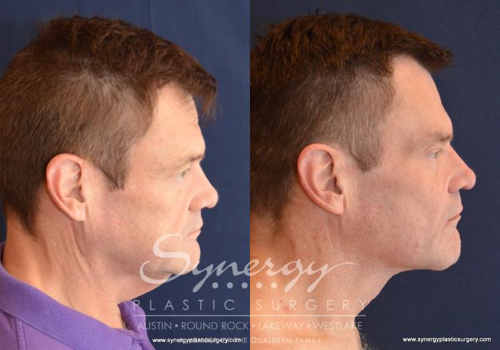 Before & After  Case 601 View #3 View in Austin, TX