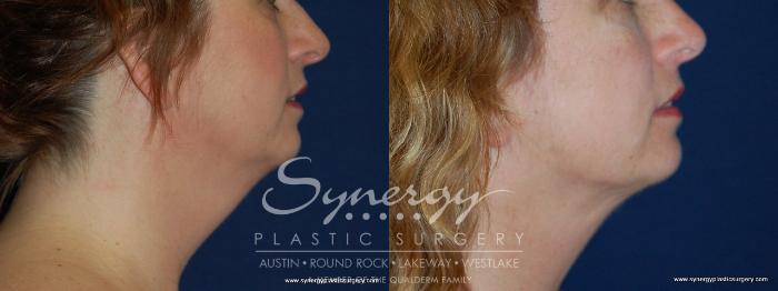 Before & After  Case 159 View #3 View in Austin, TX