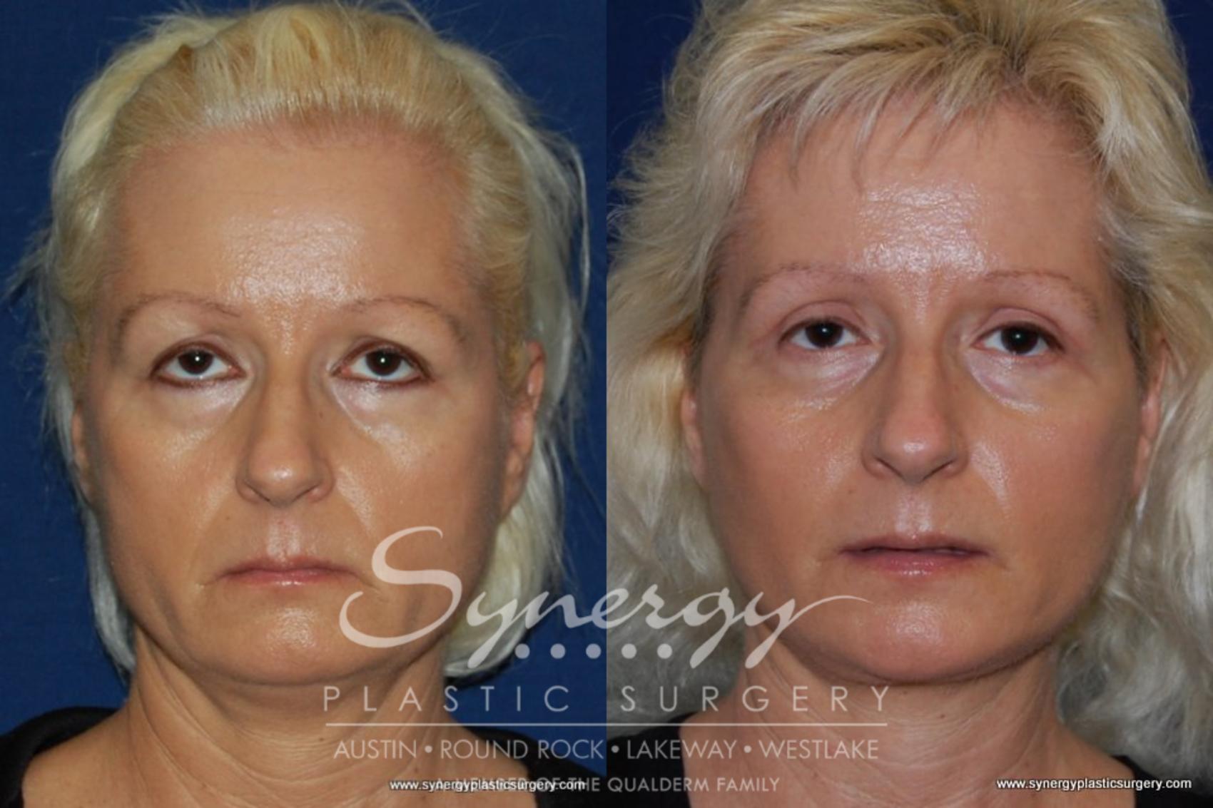 Before & After Neck Liposuction Case 194 View #1 View in Austin, TX