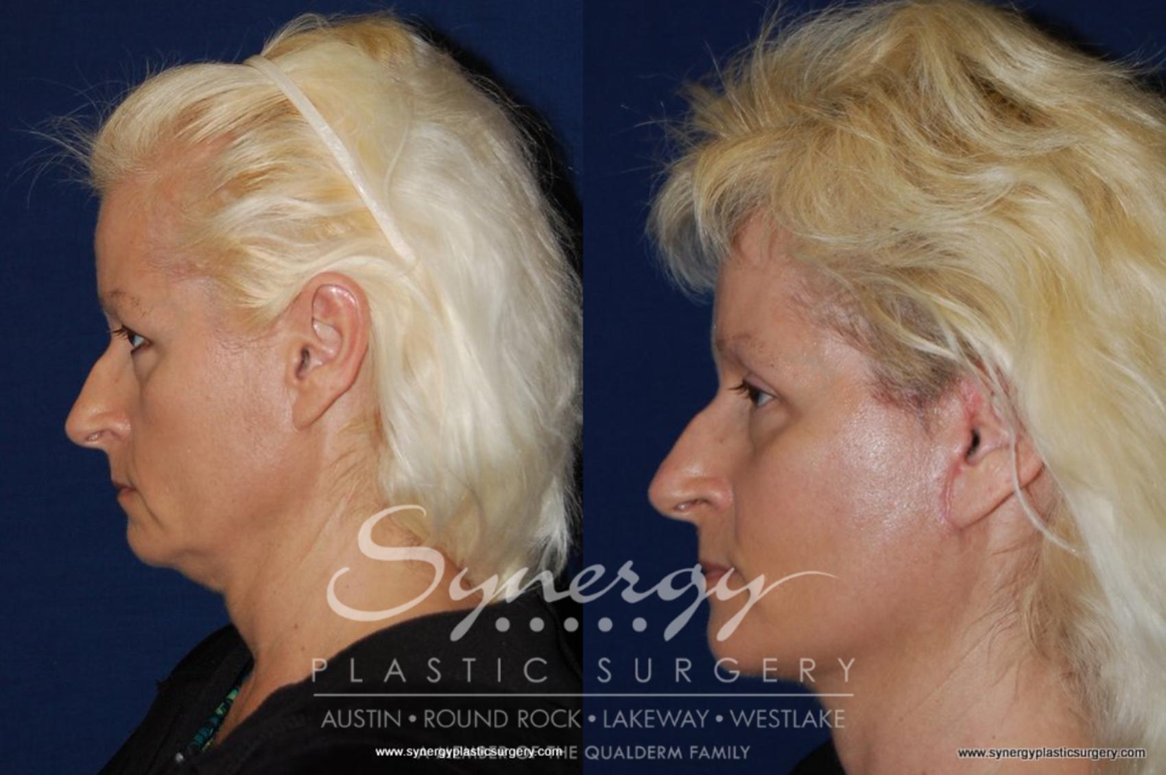 Before & After Neck Liposuction Case 194 View #2 View in Austin, TX