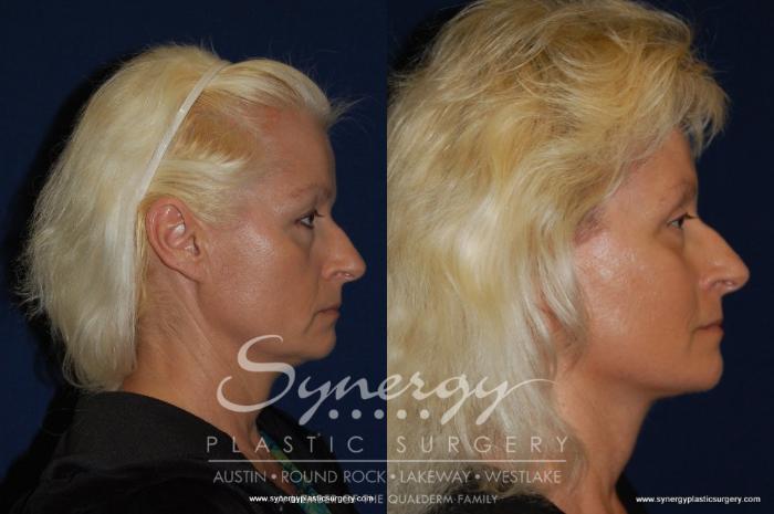 Before & After  Case 194 View #3 View in Austin, TX