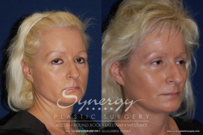 Before & After  Case 194 View #4 View in Austin, TX