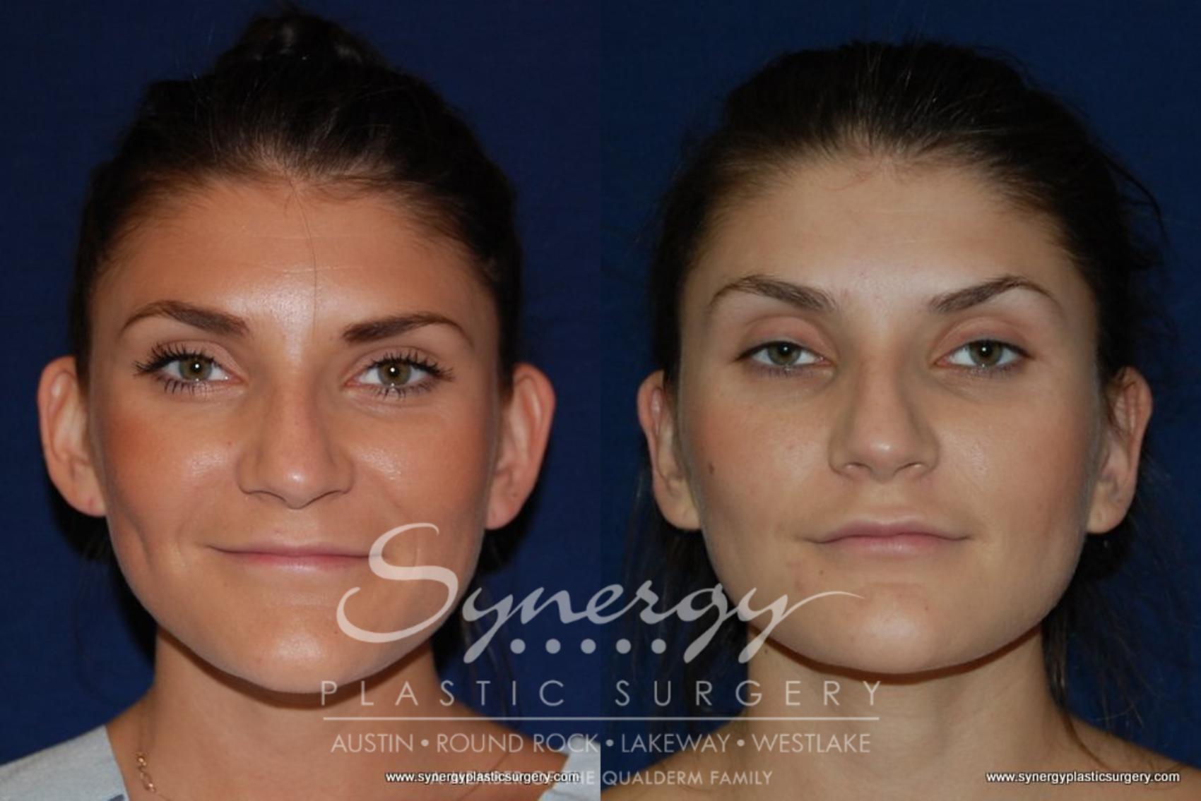 Before & After Otoplasty (Pin Back Ears) Case 175 View #1 View in Austin, TX