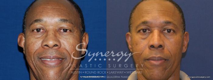 Before & After Otoplasty (Pin Back Ears) Case 252 View #1 View in Austin, TX