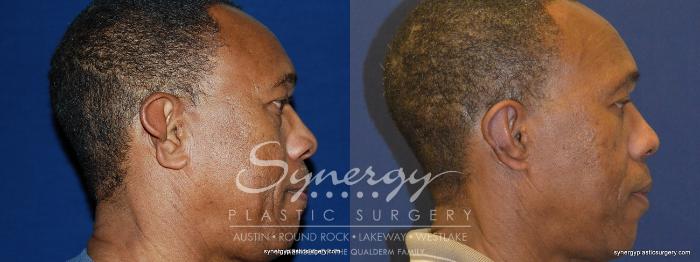 Before & After  Case 252 View #2 View in Austin, TX