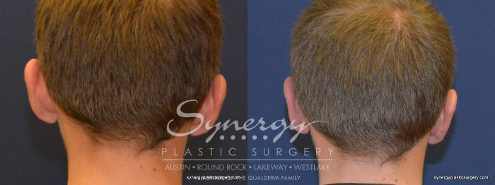 Before & After  Case 253 View #2 View in Austin, TX