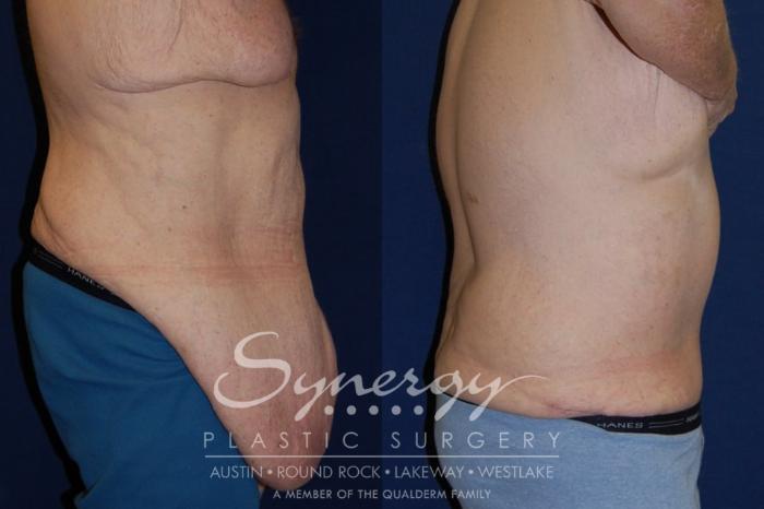 Before & After Post Weight Loss Surgery Case 118 View #1 View in Austin, TX