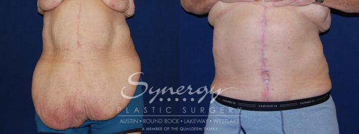 Before & After  Case 118 View #3 View in Austin, TX