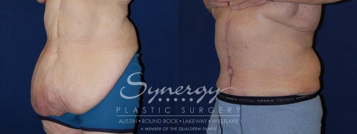 Before & After  Case 118 View #4 View in Austin, TX