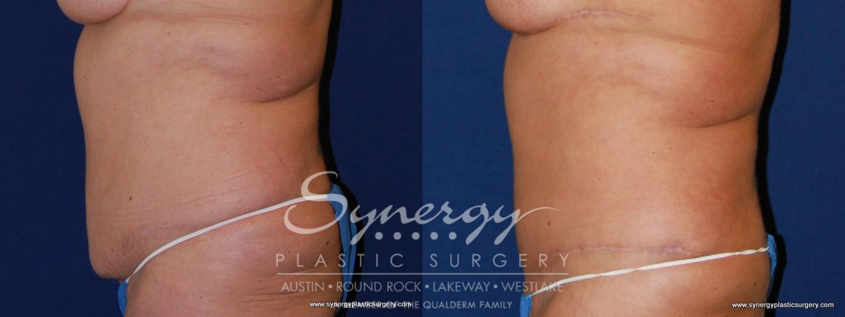 Before & After Post Weight Loss Surgery Case 173 View #1 View in Austin, TX