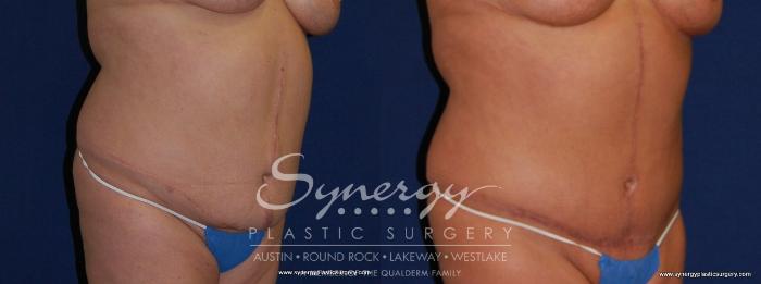 Before & After Post Weight Loss Surgery Case 173 View #3 View in Austin, TX