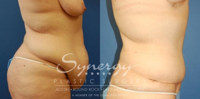 Before & After  Case 31 View #2 View in Austin, TX