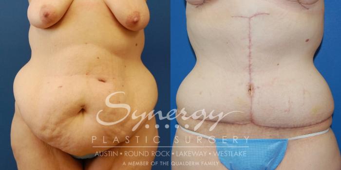 Before & After  Case 31 View #3 View in Austin, TX