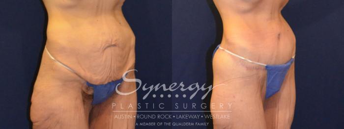 Before & After  Case 316 View #2 View in Austin, TX