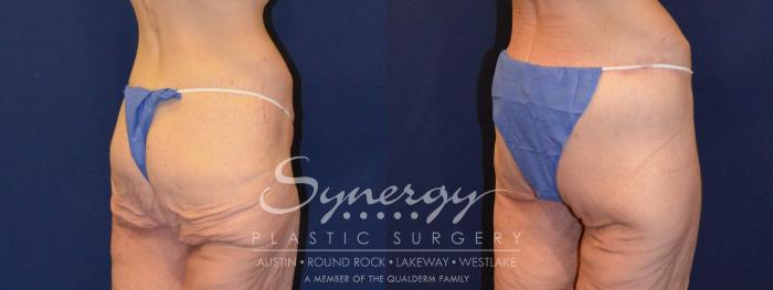 Before & After  Case 316 View #3 View in Austin, TX