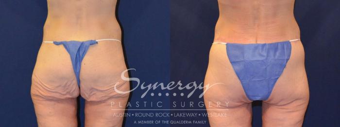 Before & After  Case 316 View #4 View in Austin, TX