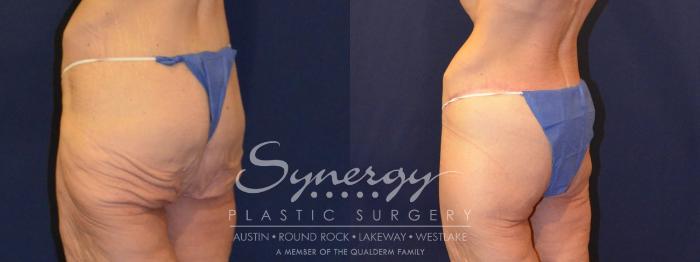 Before & After  Case 316 View #5 View in Austin, TX