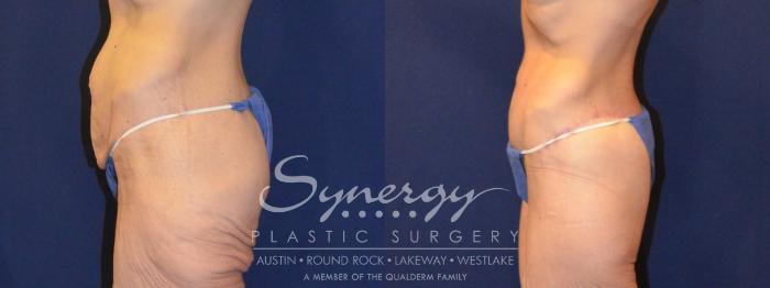 Before & After  Case 316 View #6 View in Austin, TX