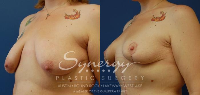 Before & After Post Weight Loss Surgery Case 37 View #2 View in Austin, TX