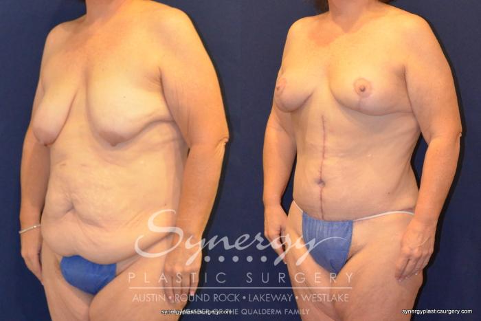 Before & After  Case 399 View #3 View in Austin, TX