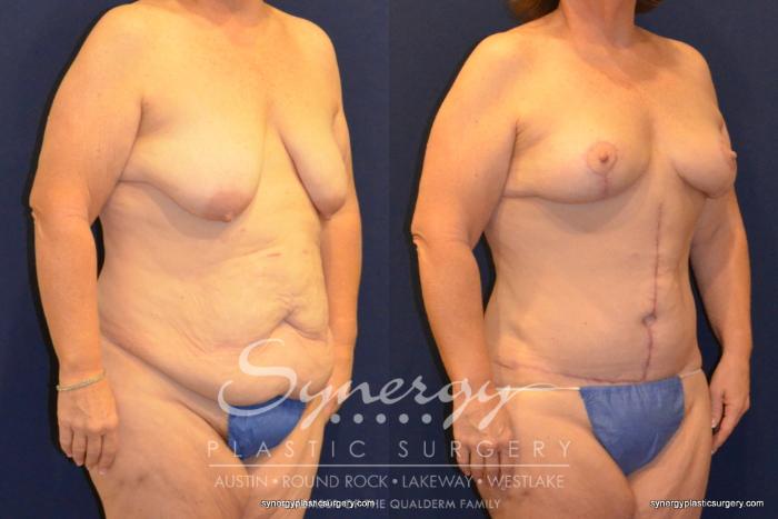 Before & After  Case 399 View #5 View in Austin, TX