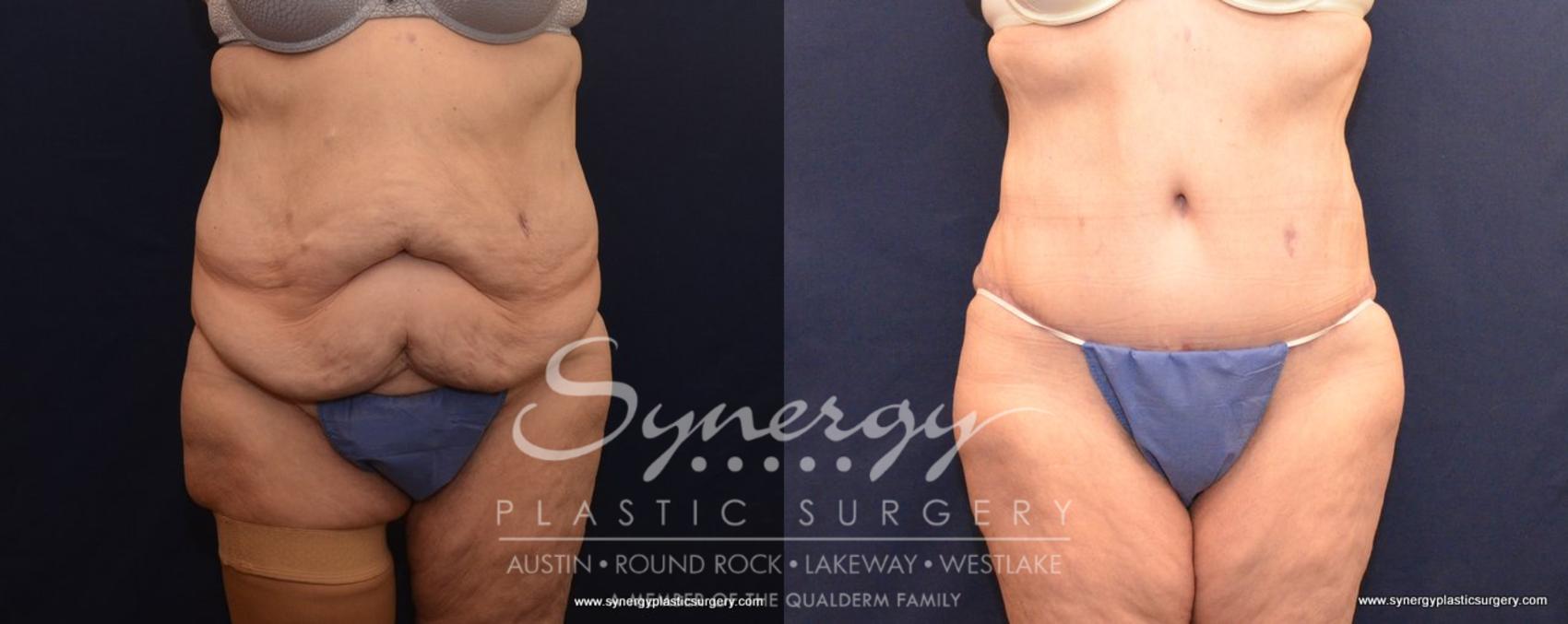 Before & After Post Weight Loss Surgery Case 499 View #1 View in Austin, TX