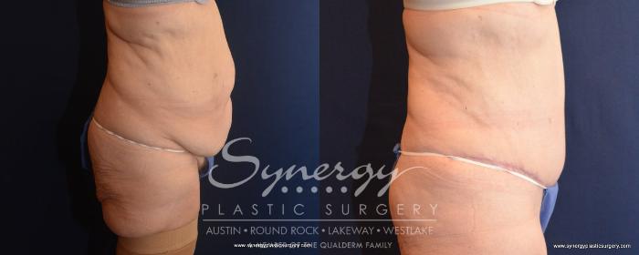 Before & After  Case 499 View #2 View in Austin, TX