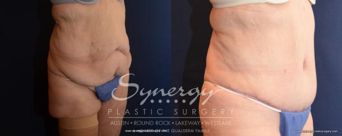 Before & After  Case 499 View #3 View in Austin, TX