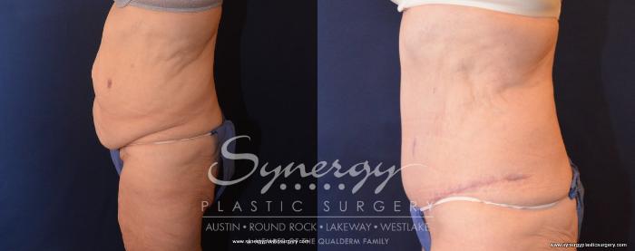 Before & After  Case 499 View #4 View in Austin, TX