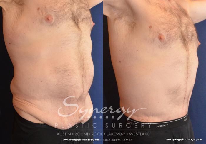 Before & After Post Weight Loss Surgery Case 599 View #2 View in Austin, TX