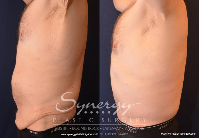 Before & After Post Weight Loss Surgery Case 599 View #5 View in Austin, TX