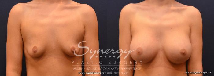 Before & After Post Weight Loss Surgery Case 640 View #1 View in Austin, TX