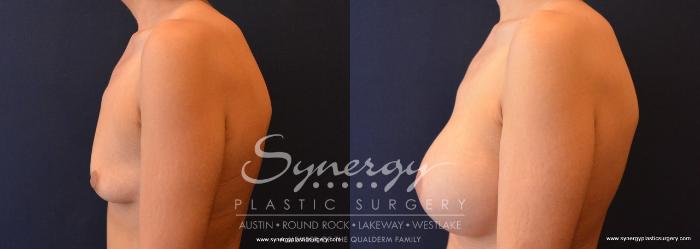 Before & After  Case 640 View #3 View in Austin, TX