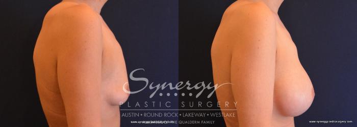 Before & After  Case 640 View #4 View in Austin, TX