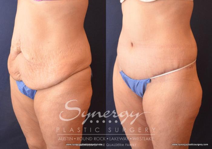 Before & After  Case 719 View #2 View in Austin, TX