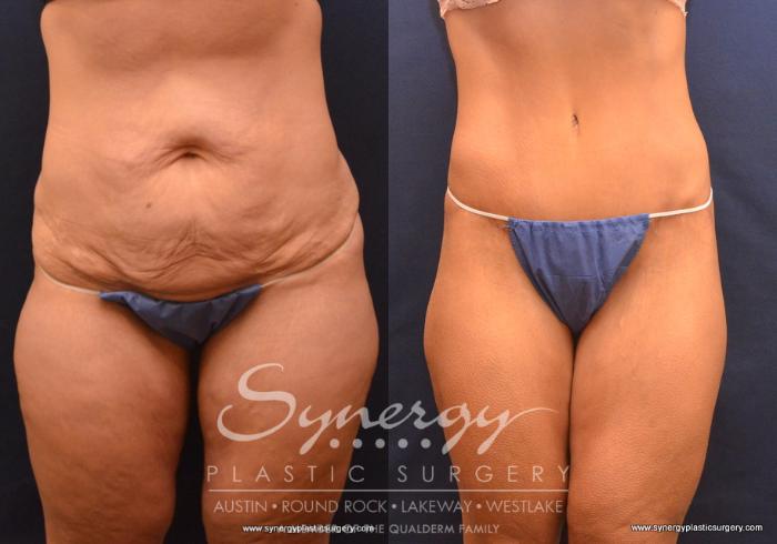 Before & After Post Weight Loss Surgery Case 735 View #1 View in Austin, TX