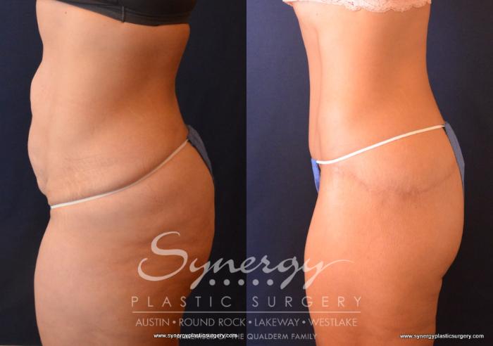 Before & After  Case 735 View #3 View in Austin, TX