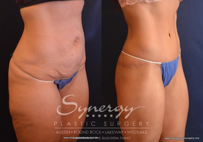 Before & After  Case 735 View #4 View in Austin, TX