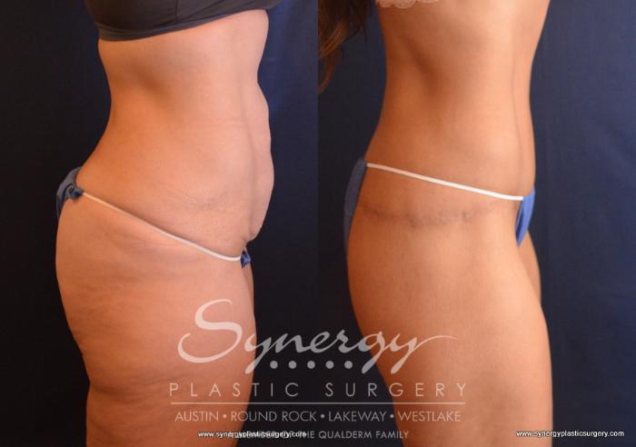 Before & After  Case 735 View #5 View in Austin, TX