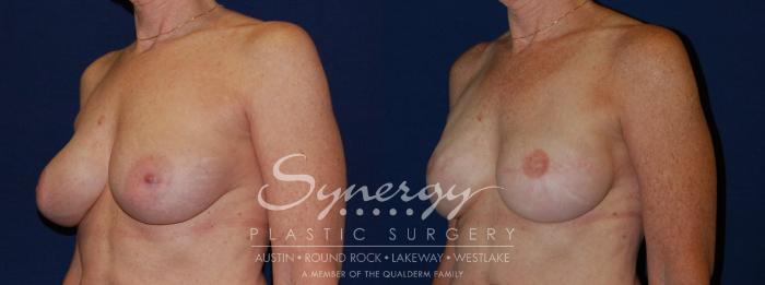 Before & After Reconstruction - Breast Cancer Case 139 View #2 View in Austin, TX