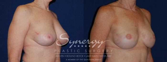 Before & After Reconstruction - Breast Cancer Case 139 View #3 View in Austin, TX