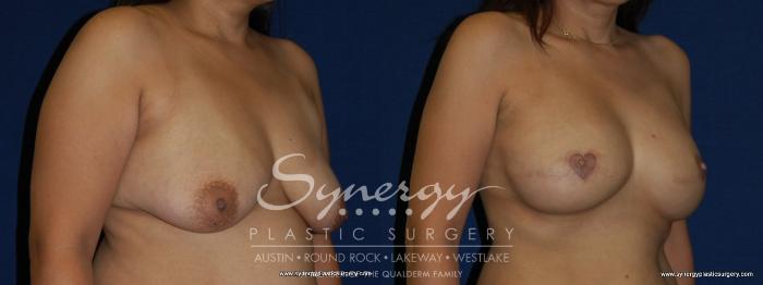 Before & After  Case 157 View #2 View in Austin, TX