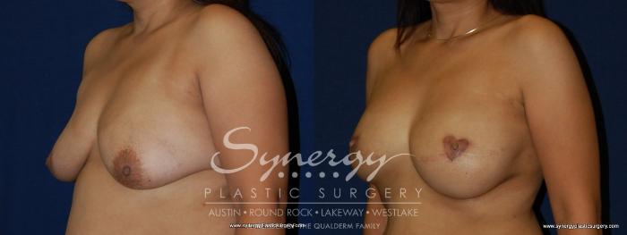 Before & After  Case 157 View #4 View in Austin, TX