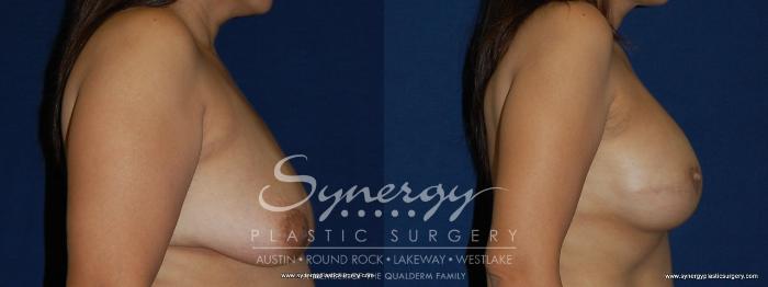 Before & After  Case 157 View #5 View in Austin, TX