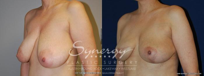 Before & After Reconstruction - Breast Cancer Case 158 View #1 View in Austin, TX