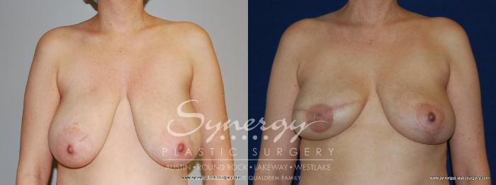 Before & After  Case 158 View #2 View in Austin, TX