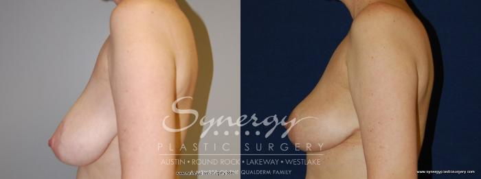 Before & After  Case 158 View #3 View in Austin, TX