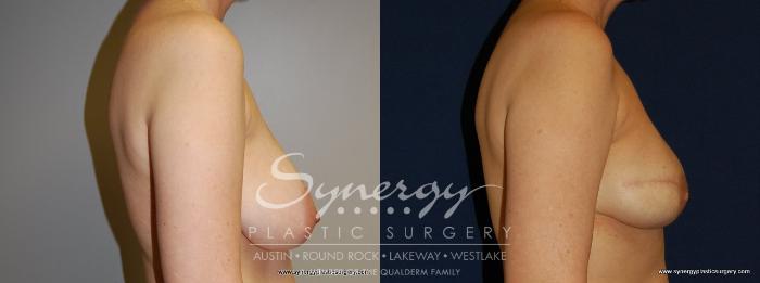 Before & After  Case 158 View #4 View in Austin, TX