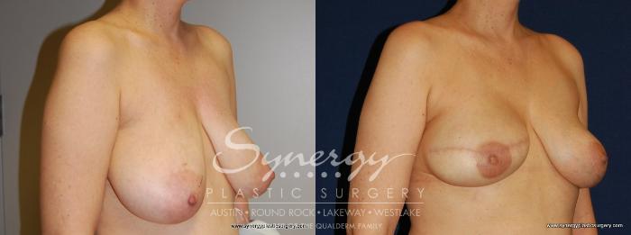 Before & After  Case 158 View #5 View in Austin, TX